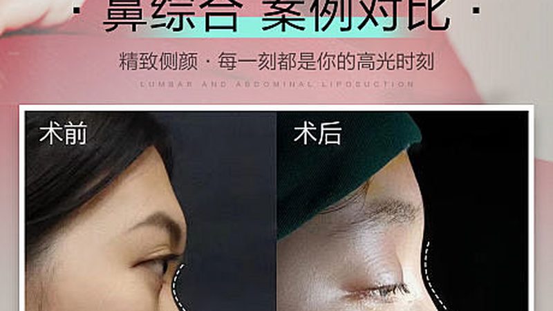 小标题：双眼皮手术，了解恢复期的关键因素