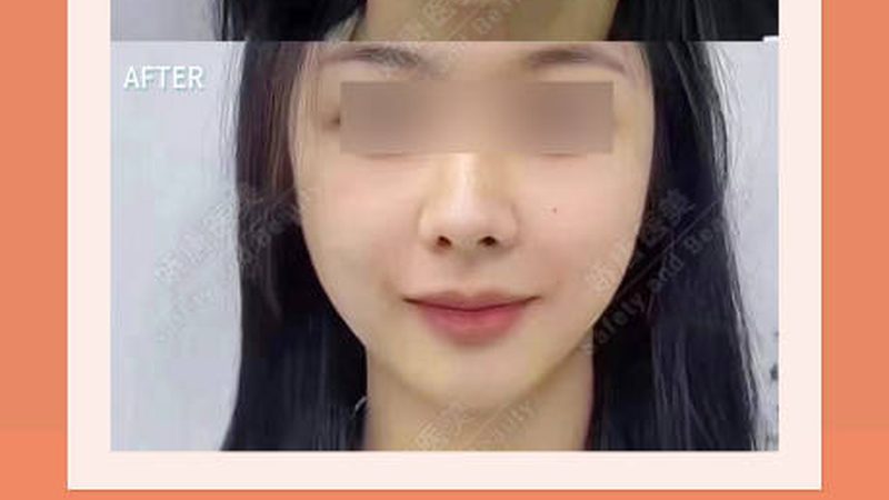 成都激光祛斑哪里做得好又便宜