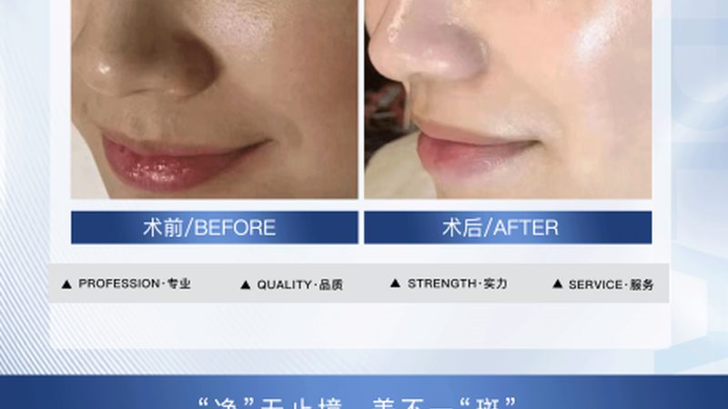 成都医美性价比之选：揭秘如何找到不贵又好的项目