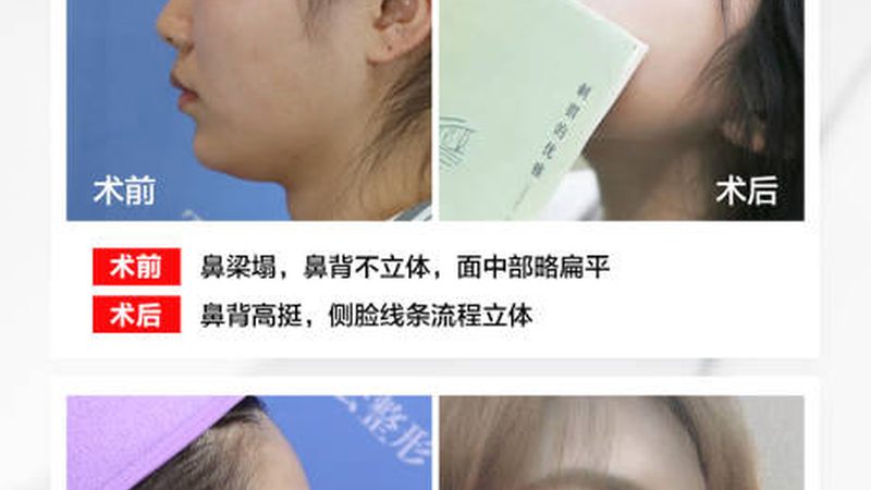 小标题：割双眼皮，常见误区盘点