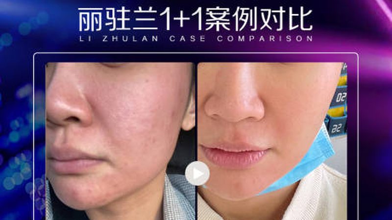 肉毒素注射后，平躺时间揭秘