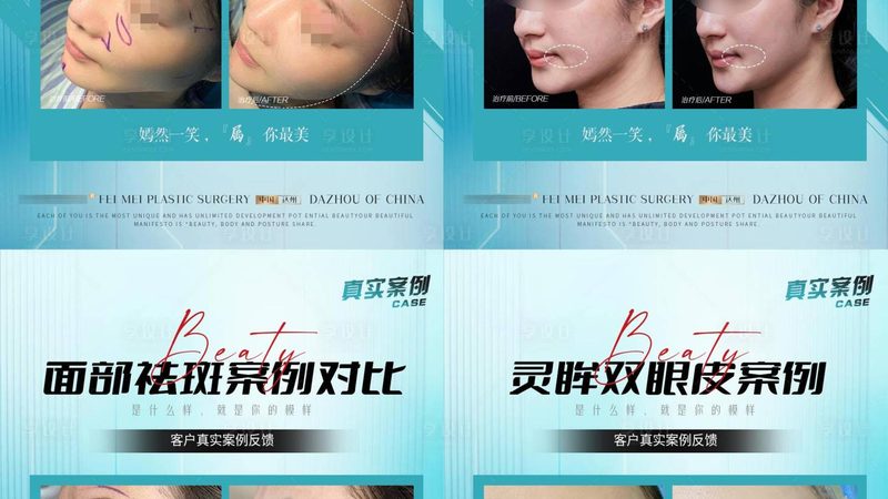 IPL激光祛斑仪：揭秘美容院专用型号的秘密