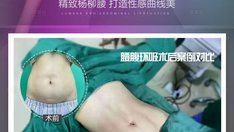 上海埋线提升，如何选择合适的材料品牌？**